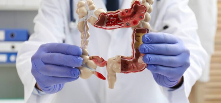 Alimentul care reduce riscul de cancer de colon. Descoperirea surprinzătoare a cercetătorilor