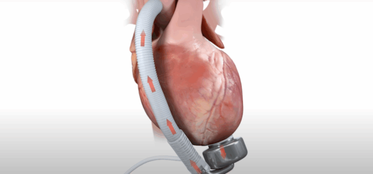 Prima pompă cardiacă cu membrană ondulată a fost implantată